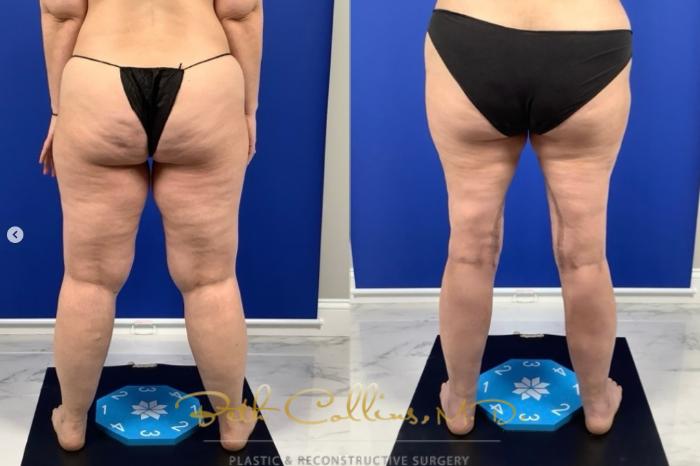 Before & After Lipedema Treatment Case 276 Back View in Guilford, CT