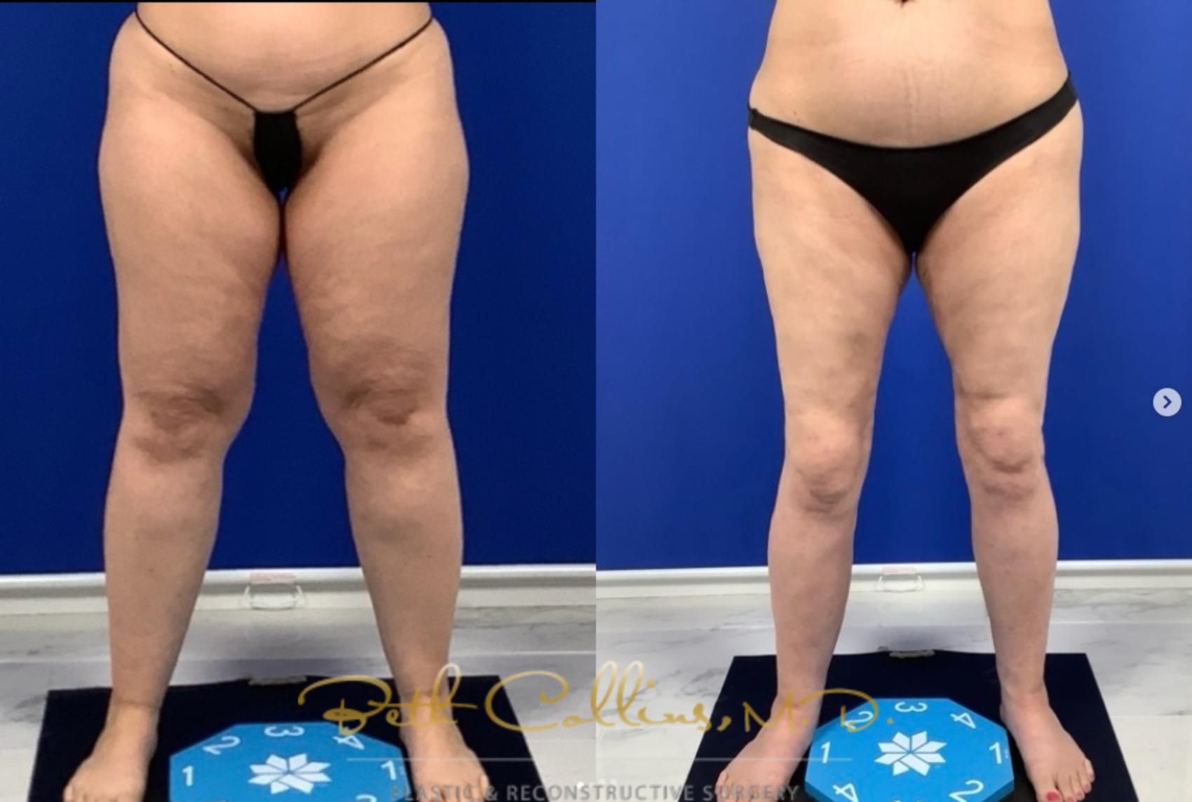 Before & After Liposuction Case 276 Front View in Guilford, CT