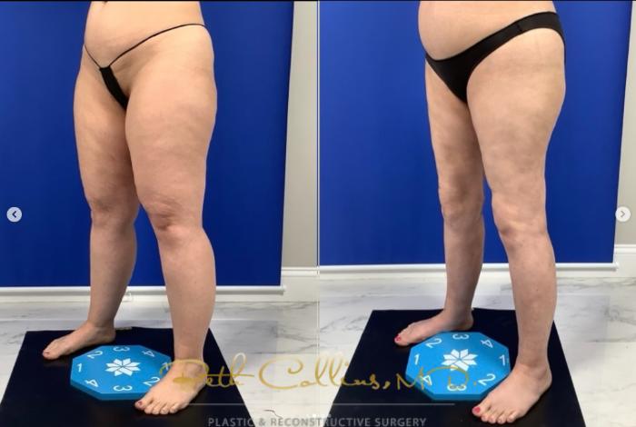 Before & After Lipedema Treatment Case 276 Left Oblique View in Guilford, CT