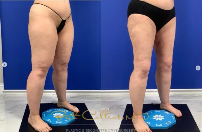 Before & After Liposuction Case 276 Right Oblique View in Guilford, CT