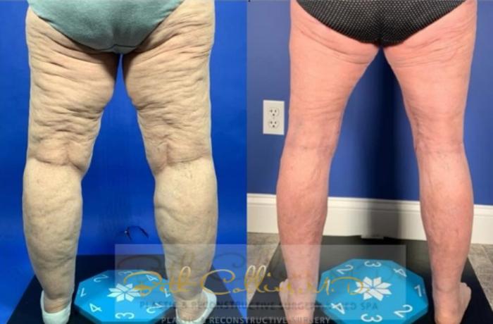 Before & After Lipedema Treatment Case 277 Back View in Guilford, CT