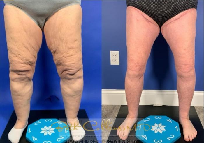 Before & After Lipedema Treatment Case 277 Front View in Guilford, CT