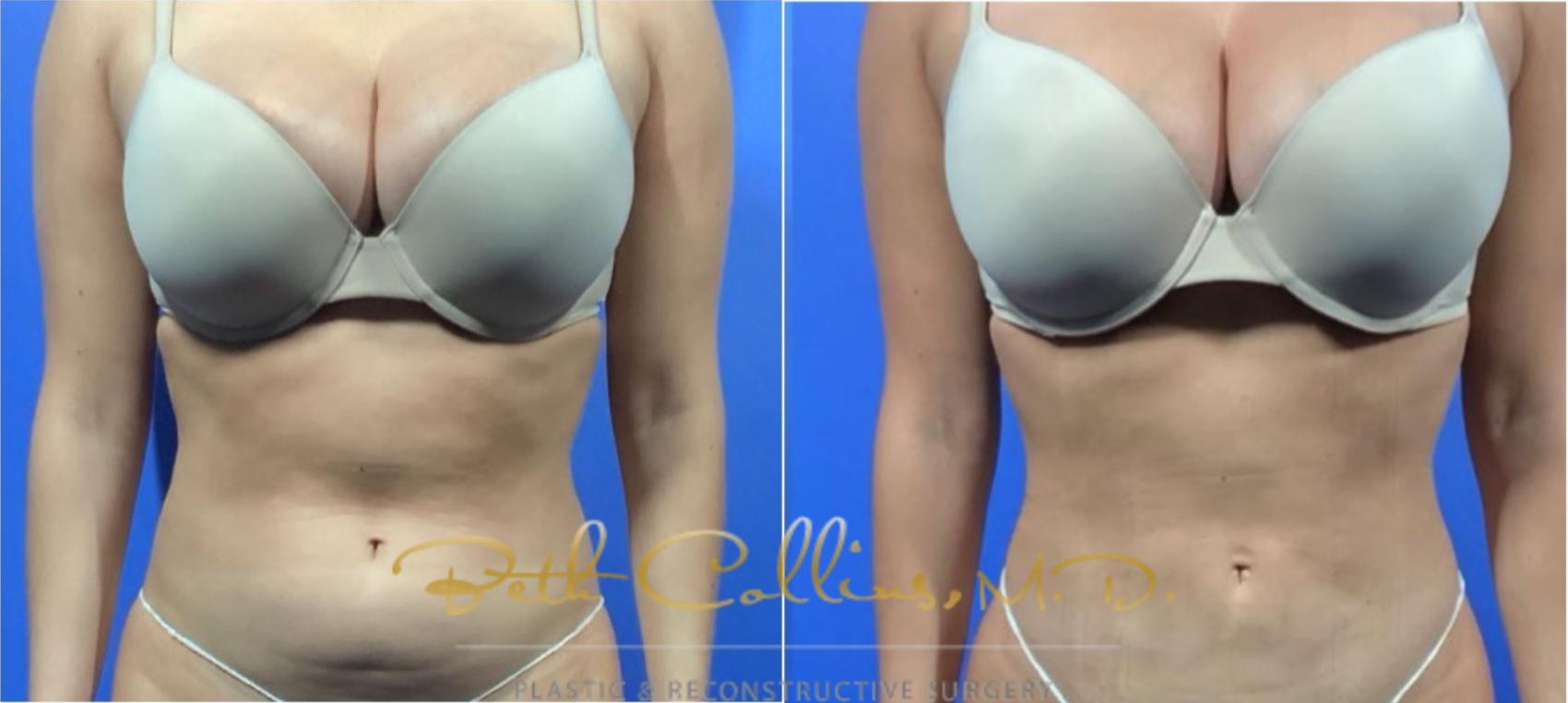 Before & After Liposuction Case 126 View #1 View in Guilford, CT