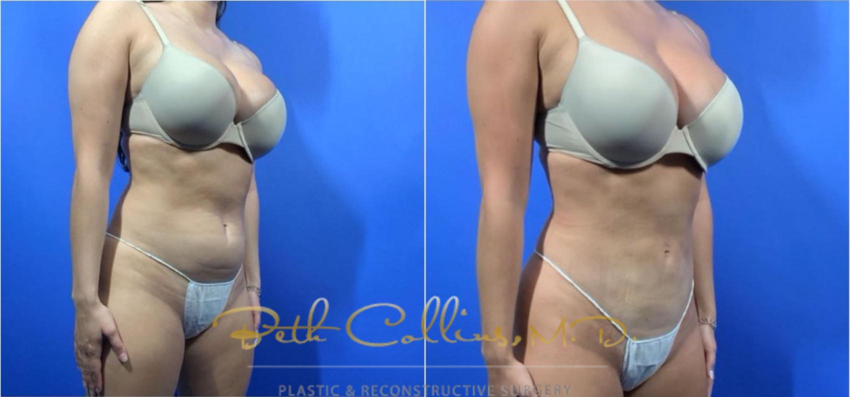 Liposuction Case 126 Before & After View #2 | Guilford, CT | Beth Collins M.D.