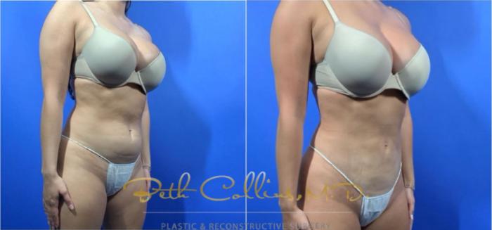 Before & After Liposuction Case 126 View #2 View in Guilford, CT