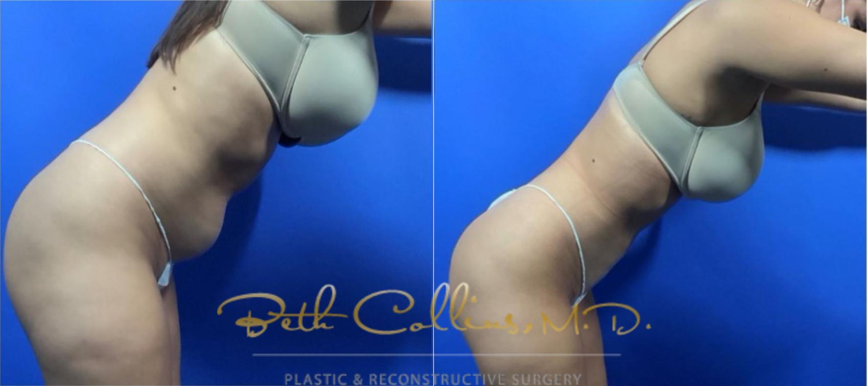 Liposuction Case 126 Before & After View #3 | Guilford, CT | Beth Collins M.D.