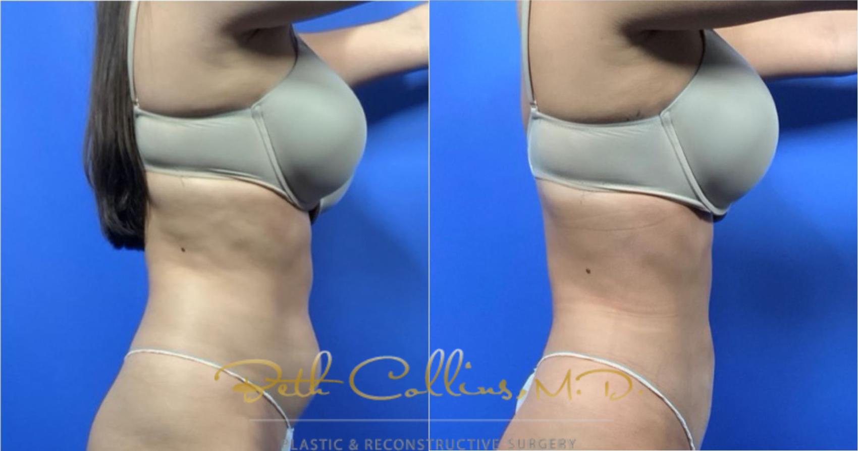 Liposuction Case 126 Before & After View #4 | Guilford, CT | Beth Collins M.D.