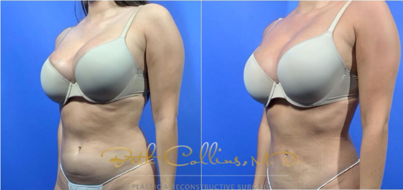 Liposuction Case 126 Before & After View #5 | Guilford, CT | Beth Collins M.D.