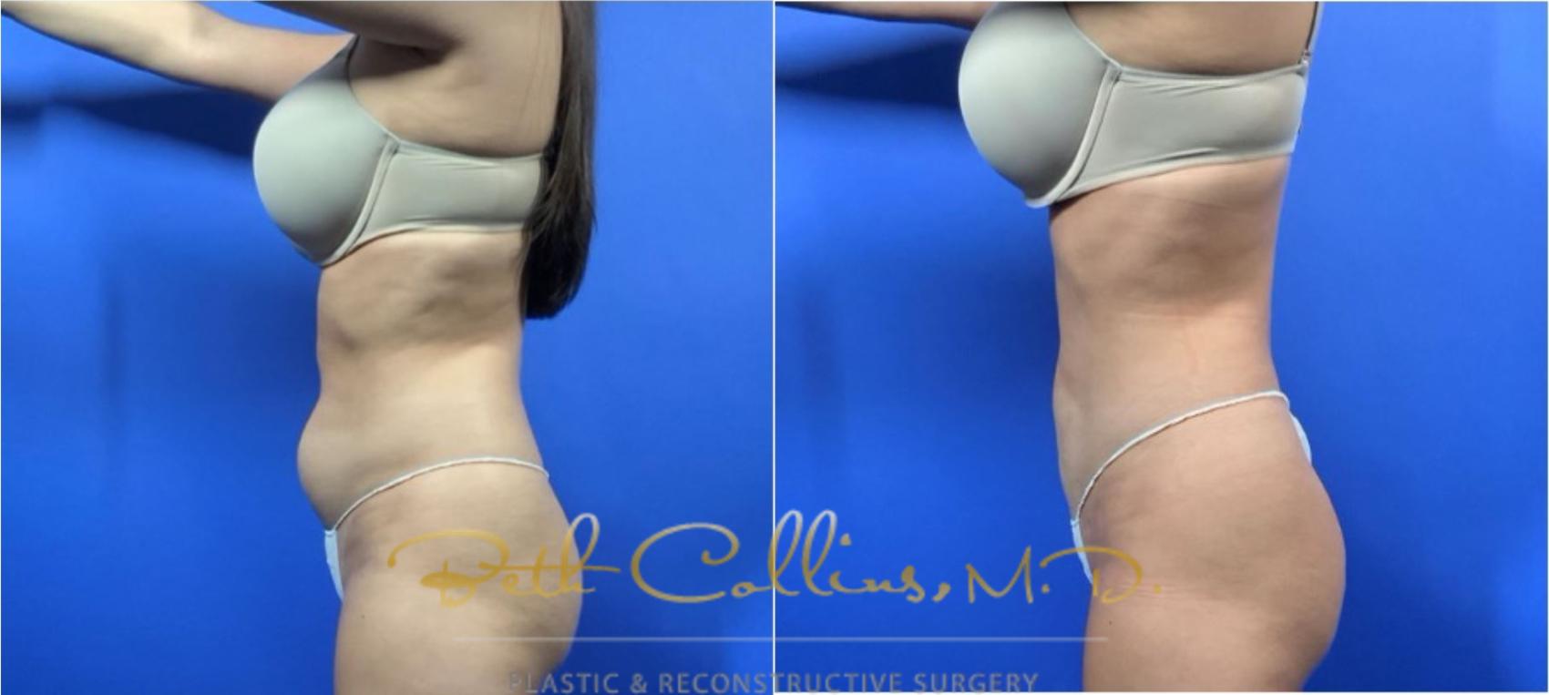 Liposuction Case 126 Before & After View #6 | Guilford, CT | Beth Collins M.D.