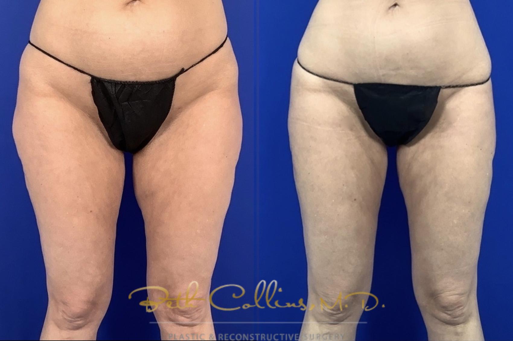 Liposuction inner and outer thighs