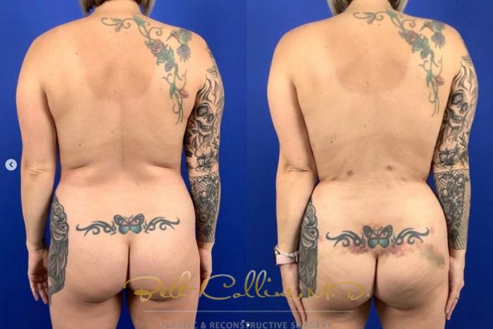 Before & After Liposuction Case 278 Back View in Guilford, CT