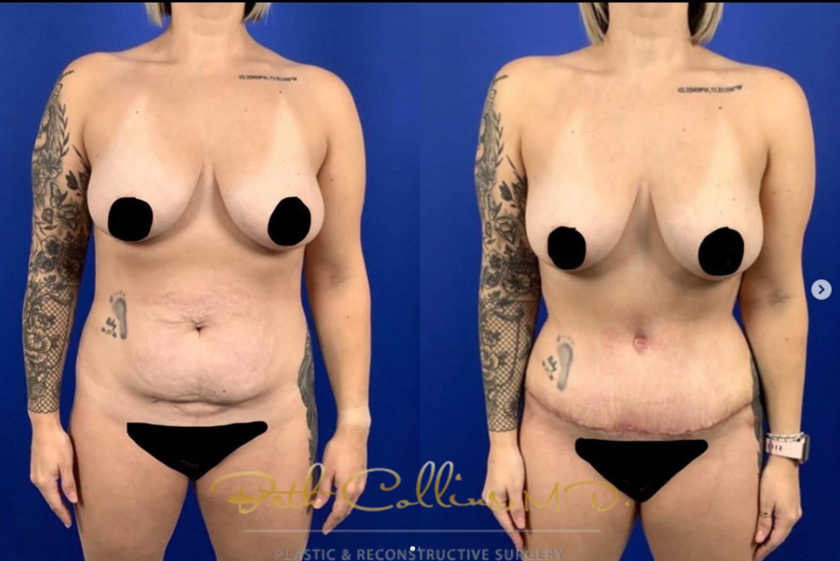 Before & After Liposuction Case 278 Front View in Guilford, CT