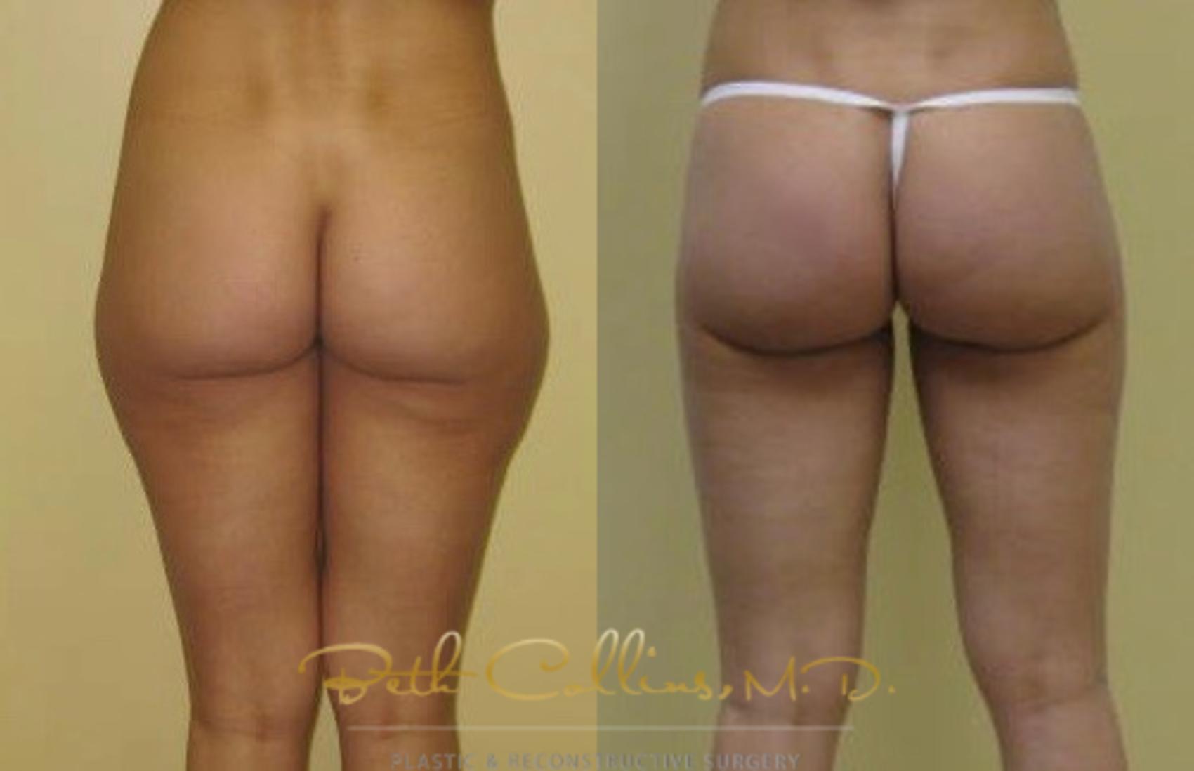 Liposuction Case 8 Before & After View #1 | Guilford, CT | Beth Collins M.D.