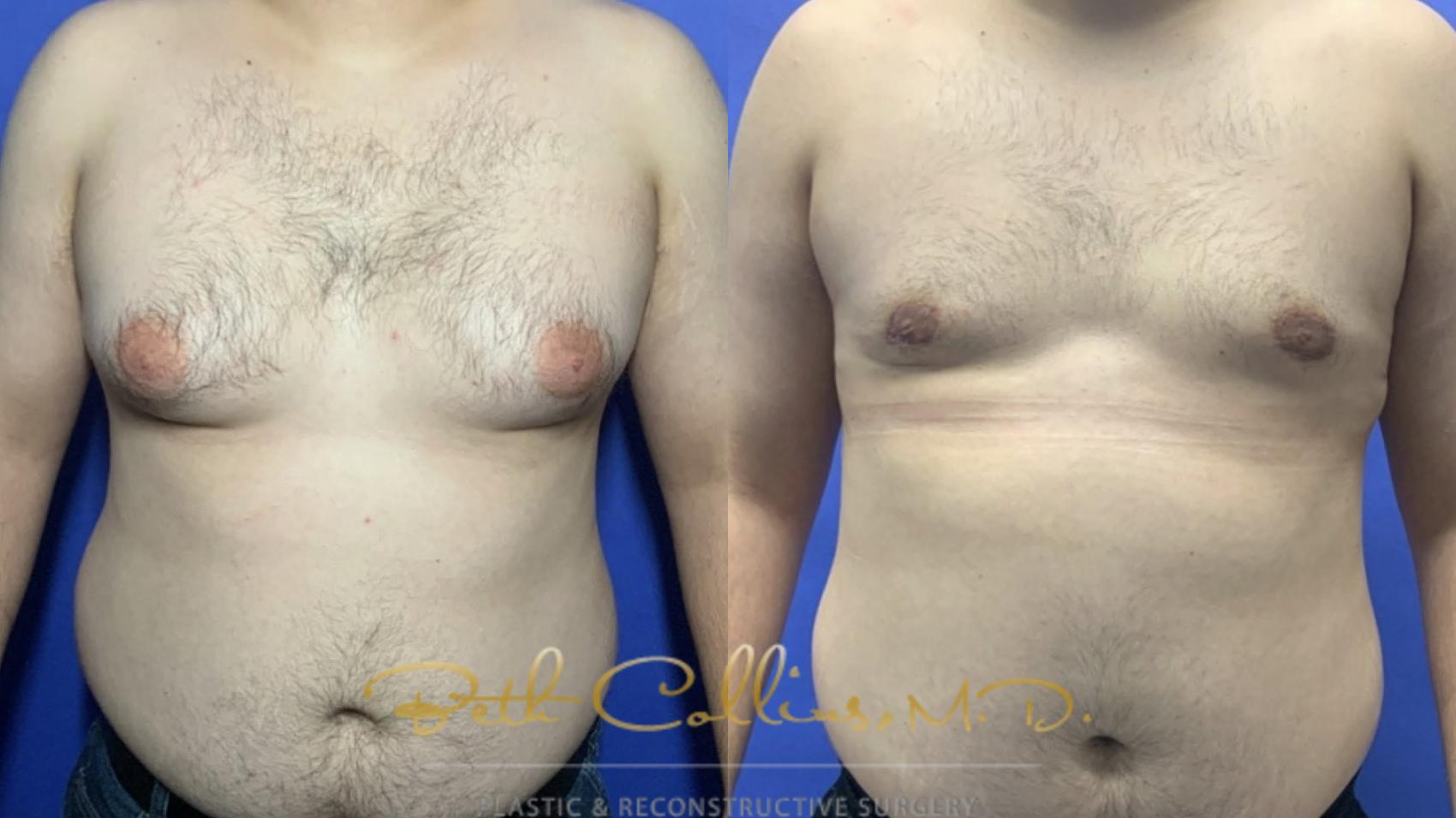 Gynecomastia Surgery: Male breast development is very common affecting up to one third of all men. A simple procedure involving liposuction and in some cases can be transformative. 
