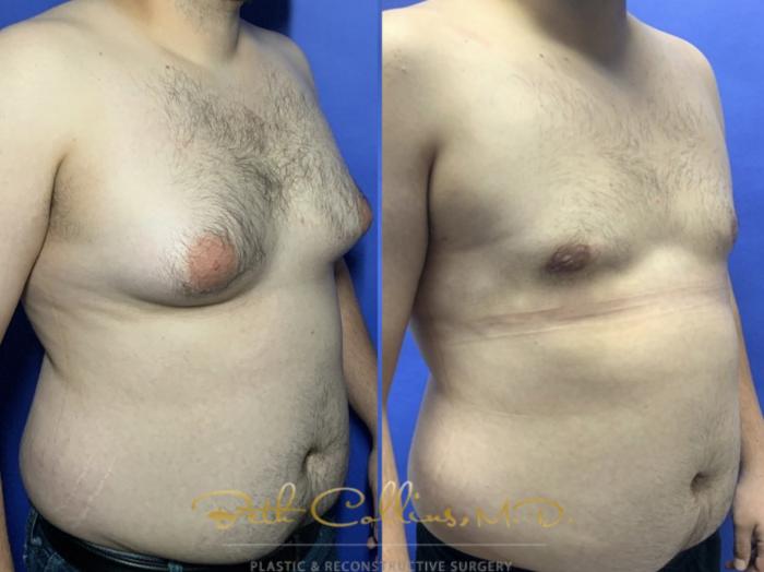 An Oblique view of before and after Gynecomastia surgery gives a good impression of the improvement both physically and emotionally that can be gained in one simple surgical procedure.