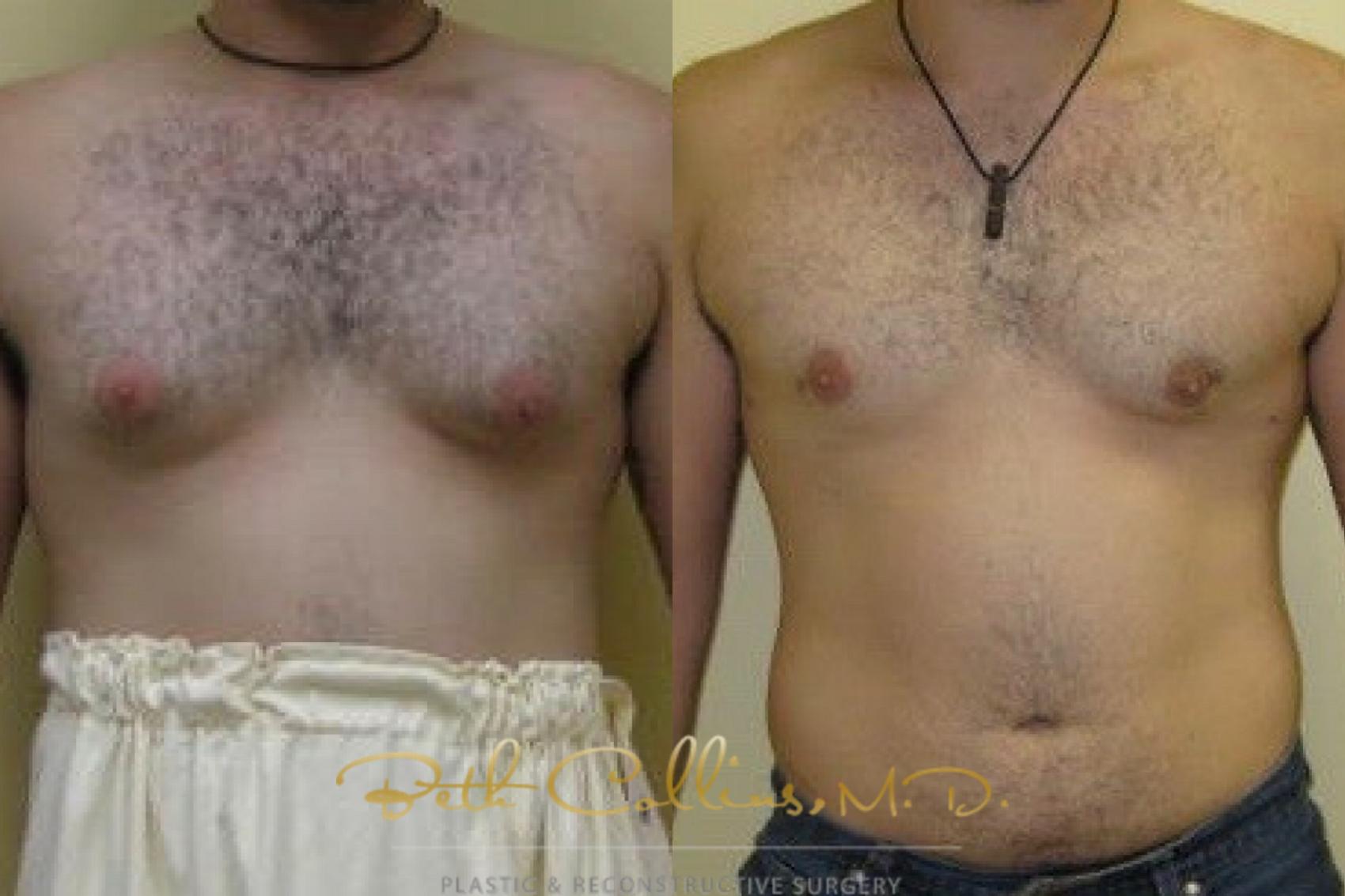 Before & After Male Breast Reduction Case 81 Front View in Guilford, CT
