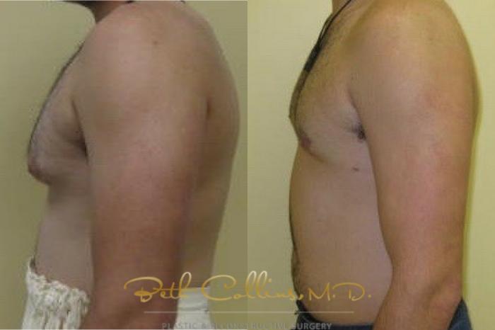 Before & After Male Breast Reduction Case 81 Left Side View in Guilford, CT