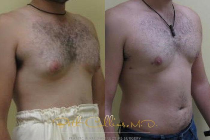 Before & After Male Breast Reduction Case 81 Right Oblique View in Guilford, CT
