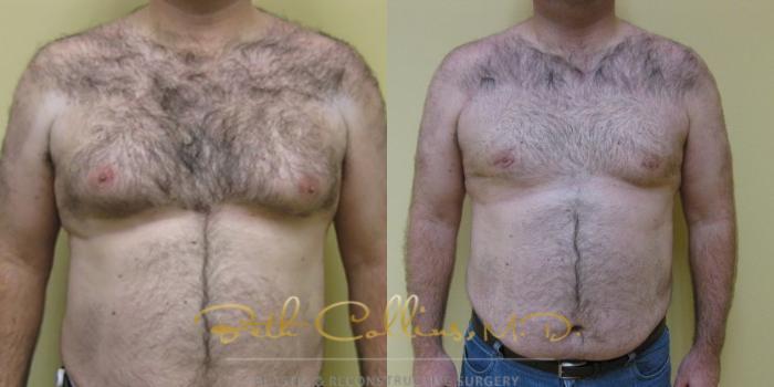 Before & After Male Breast Reduction Case 82 View #1 View in Guilford, CT