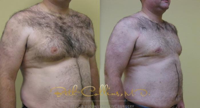 Before & After Male Breast Reduction Case 82 View #2 View in Guilford, CT