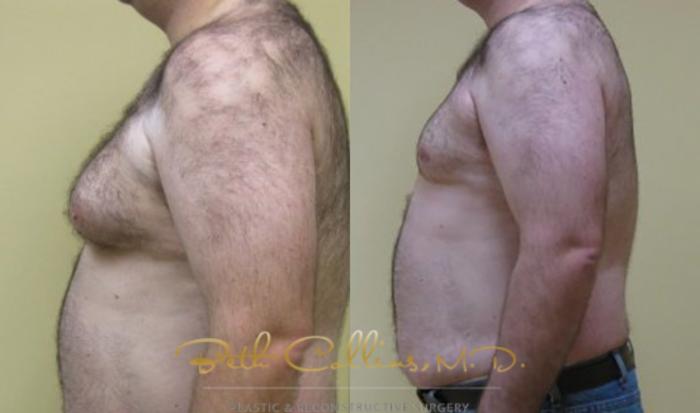 Before & After Male Breast Reduction Case 82 View #3 View in Guilford, CT