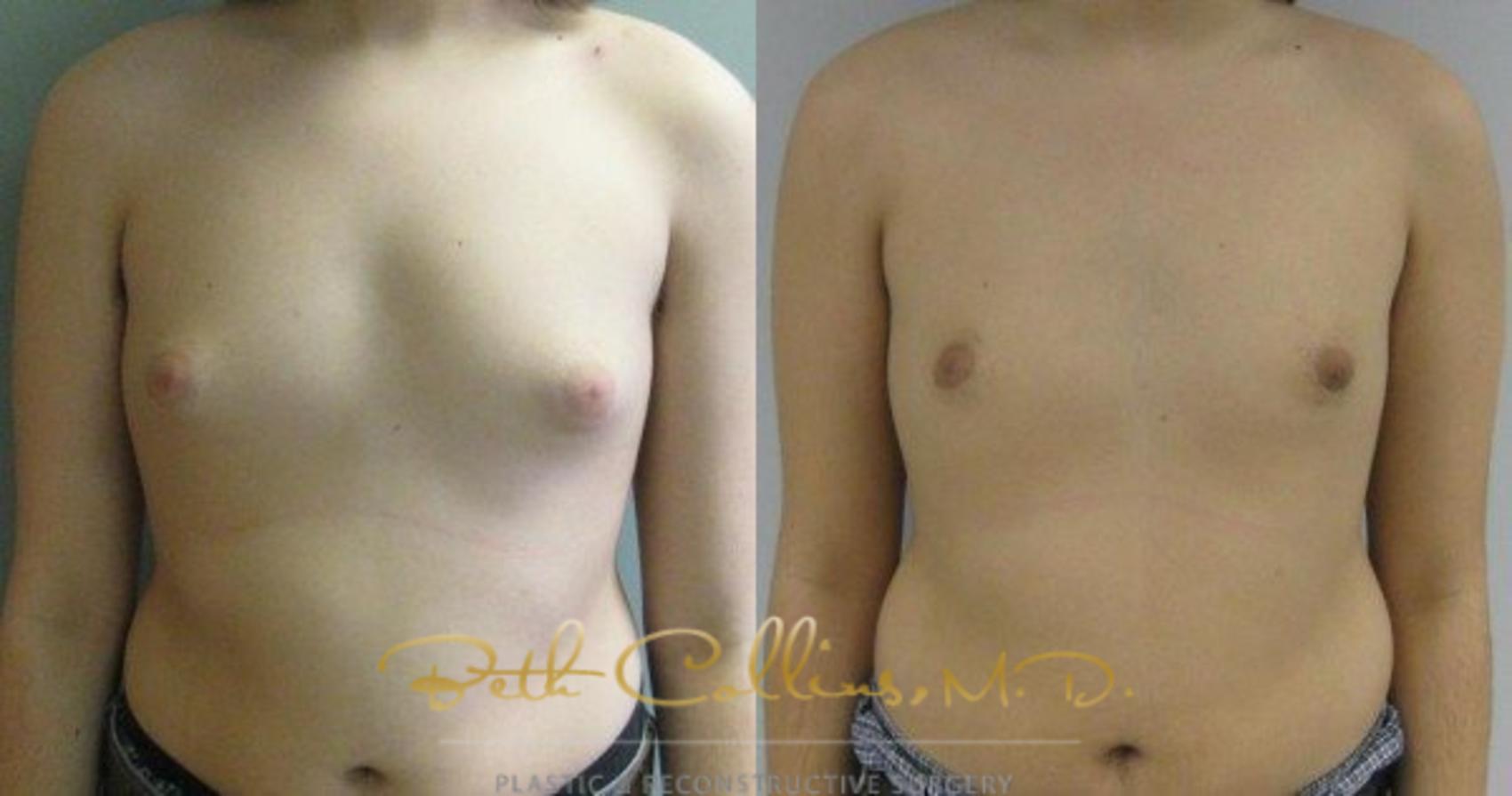 Before & After Male Breast Reduction Case 83 View #1 View in Guilford, CT