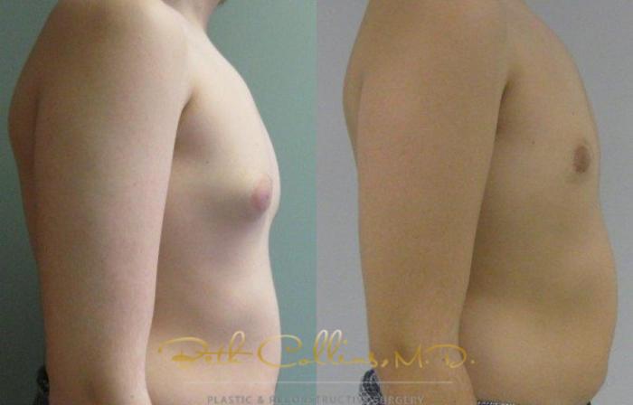 Before & After Male Breast Reduction Case 83 View #2 View in Guilford, CT