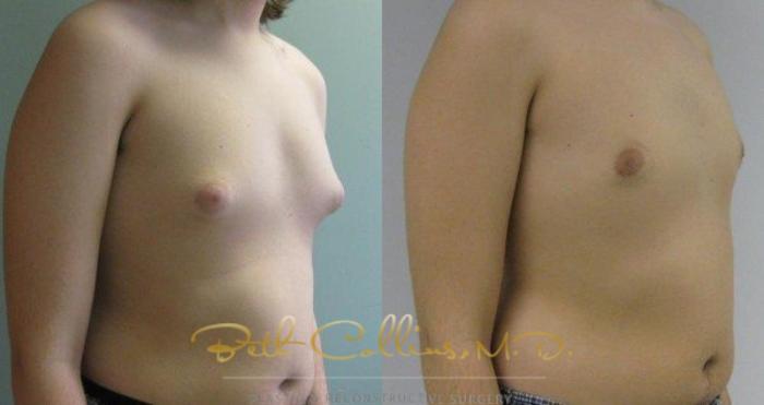 Before & After Male Breast Reduction Case 83 View #3 View in Guilford, CT