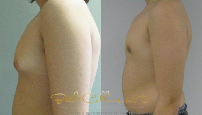 Male Breast Reduction Before and After Pictures Case 83, Guilford, CT