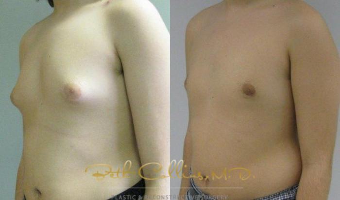 Before & After Male Breast Reduction Case 83 View #5 View in Guilford, CT