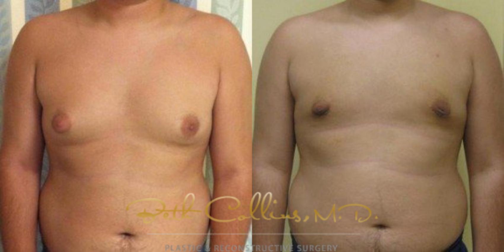 Liposuction Case 85 Before & After View #1 | Guilford, CT | Beth Collins M.D.