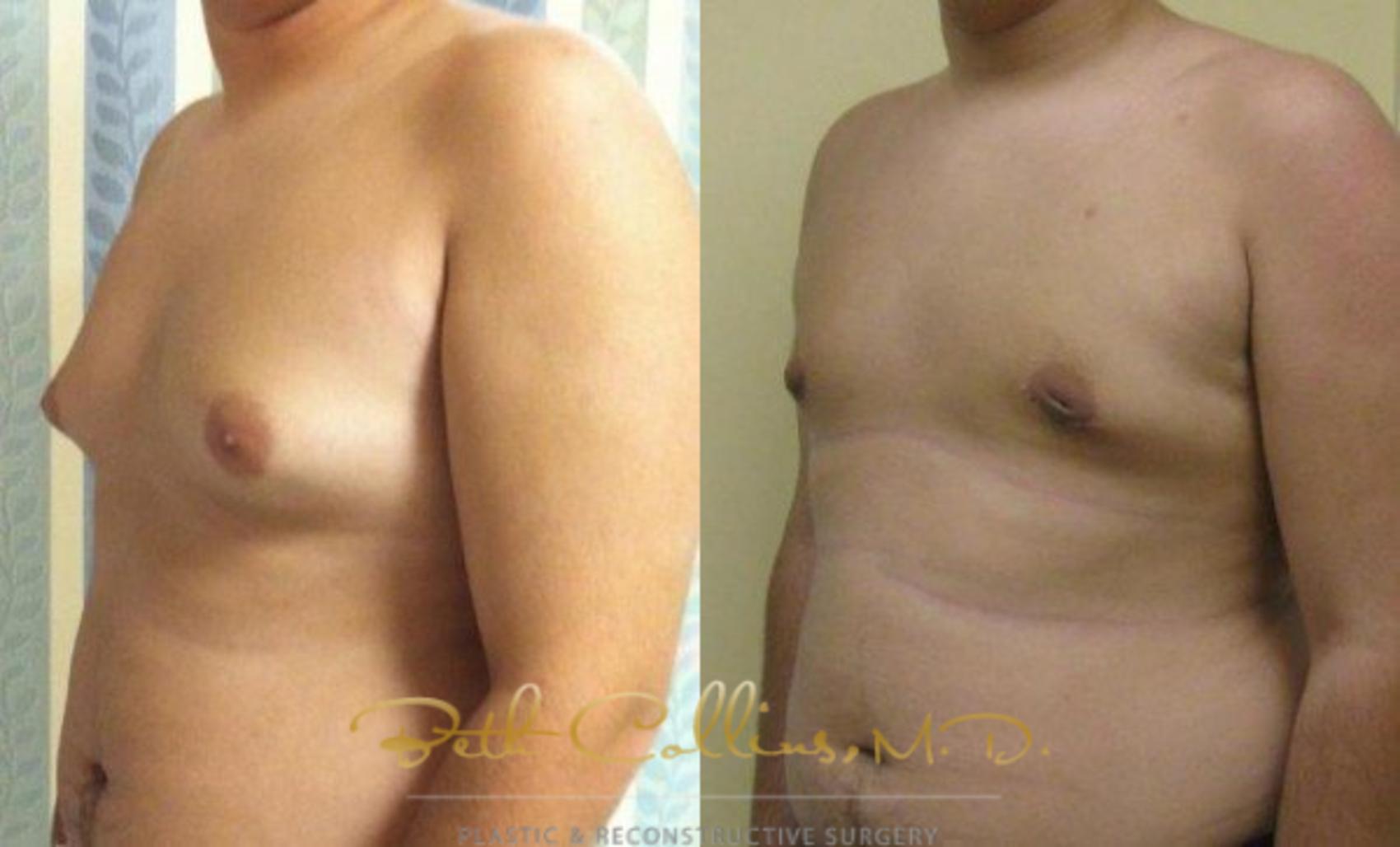 Liposuction Case 85 Before & After View #2 | Guilford, CT | Beth Collins M.D.