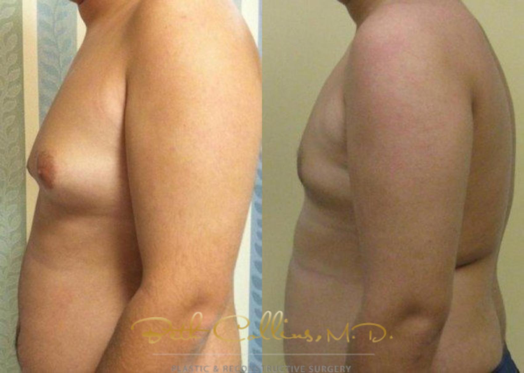Male Breast Reduction Case 85 Before & After View #3 | Guilford, CT | Beth Collins M.D.