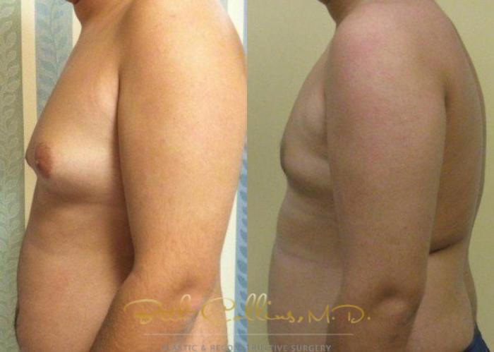 Before & After Male Breast Reduction Case 85 View #3 View in Guilford, CT