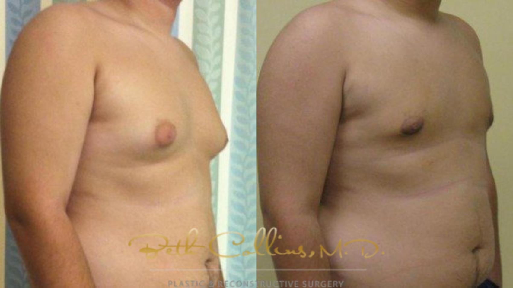 Liposuction Case 85 Before & After View #4 | Guilford, CT | Beth Collins M.D.