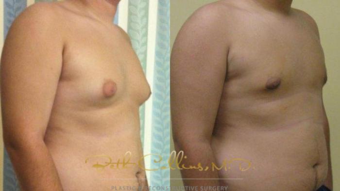 Before & After Male Breast Reduction Case 85 View #4 View in Guilford, CT
