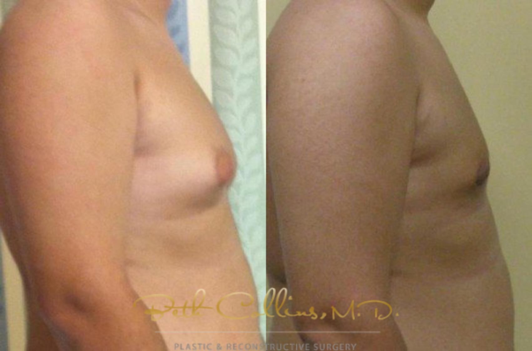 Liposuction Case 85 Before & After View #5 | Guilford, CT | Beth Collins M.D.