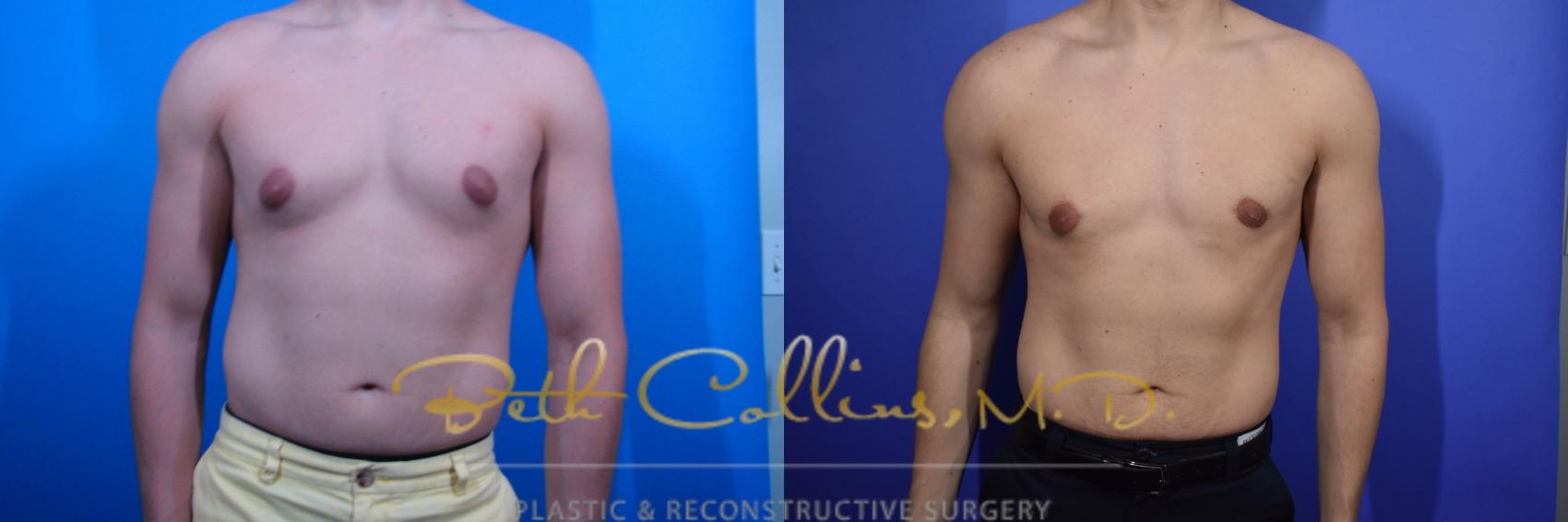 Before & After Male Breast Reduction Case 97 View #1 View in Guilford, CT