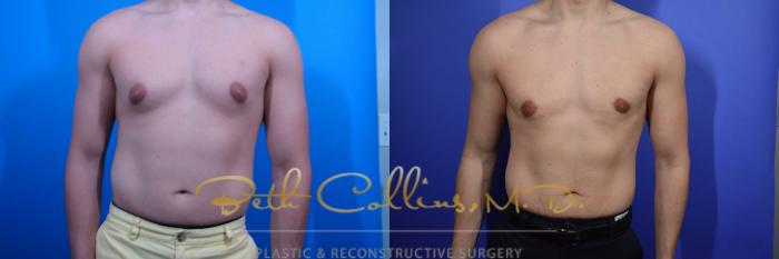 Before & After Liposuction Case 97 View #1 View in Guilford, CT