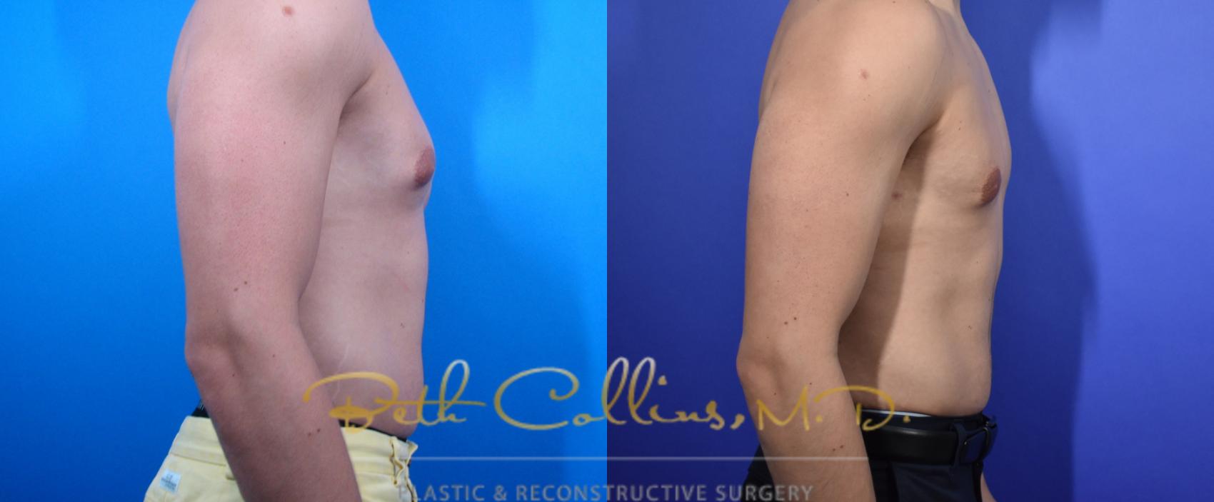 Male Breast Reduction Case 97 Before & After View #2 | Guilford, CT | Beth Collins M.D.