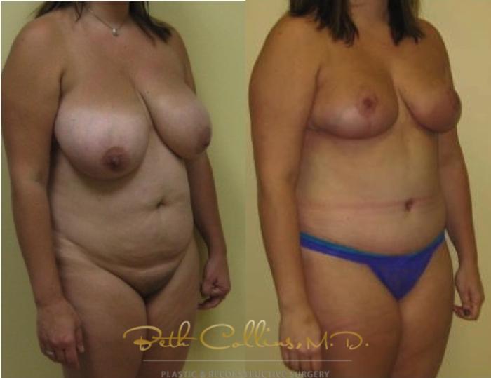 Before & After Tummy Tuck Case 114 View #2 View in Guilford, CT