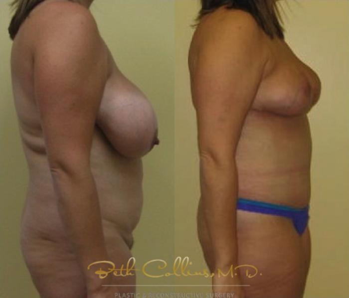 Before & After Breast Asymmetry Correction Case 114 View #3 View in Guilford, CT
