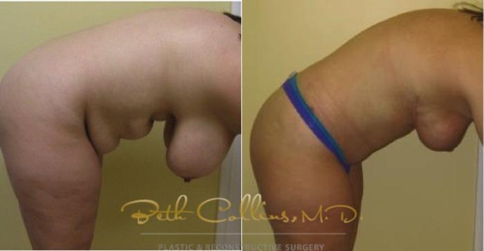 Before & After Breast Lift Case 114 View #4 View in Guilford, CT