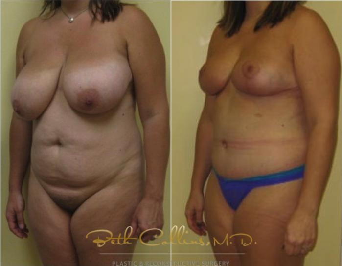 Before & After Tummy Tuck Case 114 View #5 View in Guilford, CT