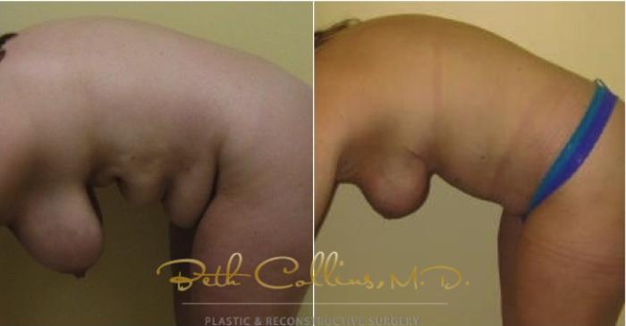 Before & After Tummy Tuck Case 114 View #6 View in Guilford, CT