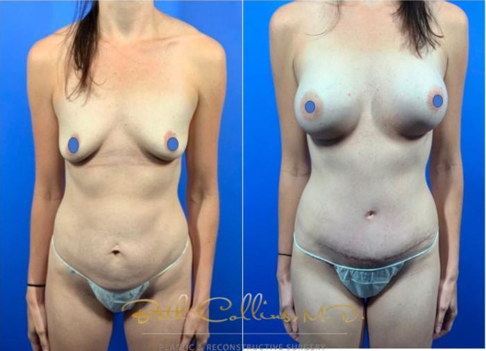 Before & After Tummy Tuck Case 122 View #1 View in Guilford, CT