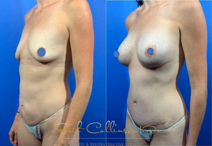 Before & After Breast Augmentation Case 122 View #2 View in Guilford, CT