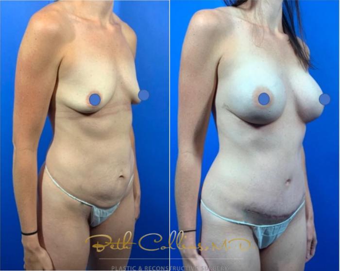 Before & After Breast Augmentation Case 122 View #3 View in Guilford, CT