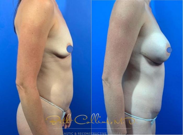 Before & After Breast Augmentation Case 122 View #4 View in Guilford, CT