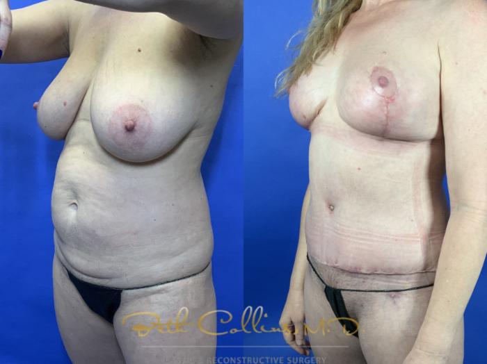 Mommy Makeover: With pregnancy comes stretching and ultimately wrinkling and sagging. This can present itself in many different ways. Most often, women seeking a mommy makeover want something done to their abdomen and breasts. This lovely lady was in great shape, but her breasts were deflated and she hated the texture of her skin on her abdomen. We did a breast reduction and a tummy tuck to achieve these nice results.